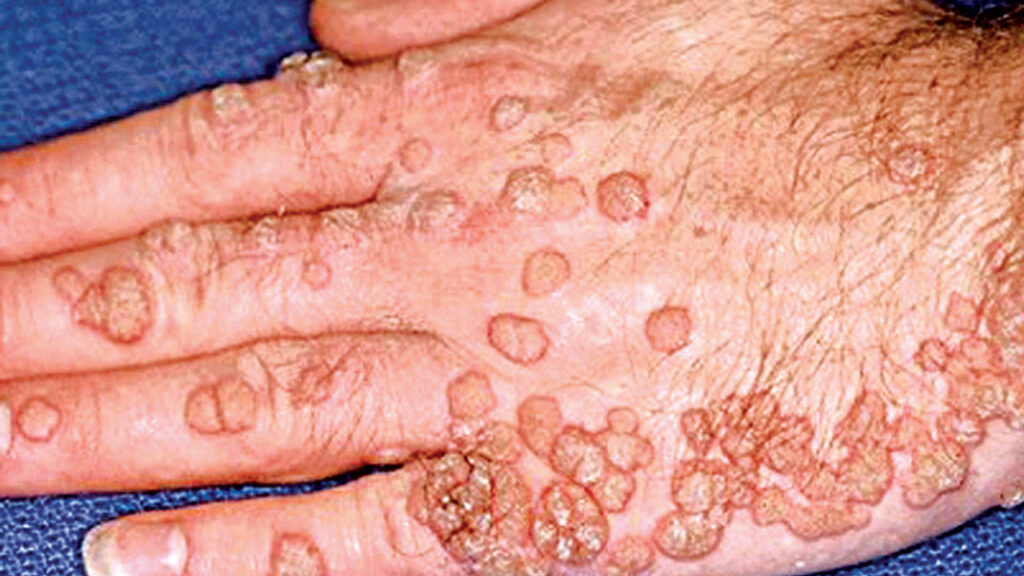 Human Papillomavirus (HPV):