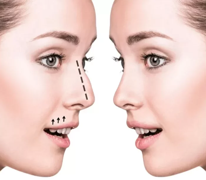 Redefine your beauty with personalized nose filler injections