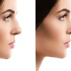 فيلر الانف والجراحات التجميلية للانف