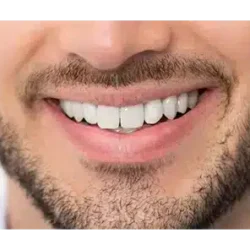 Veneers dubai best smile